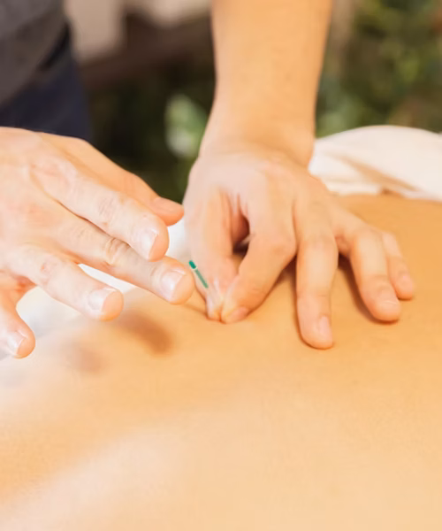 Ein Therapeut der Chiropraxis Ulm führt eine Akupunkturbehandlung am Rücken eines Patienten durch, um Schmerzen zu lindern.